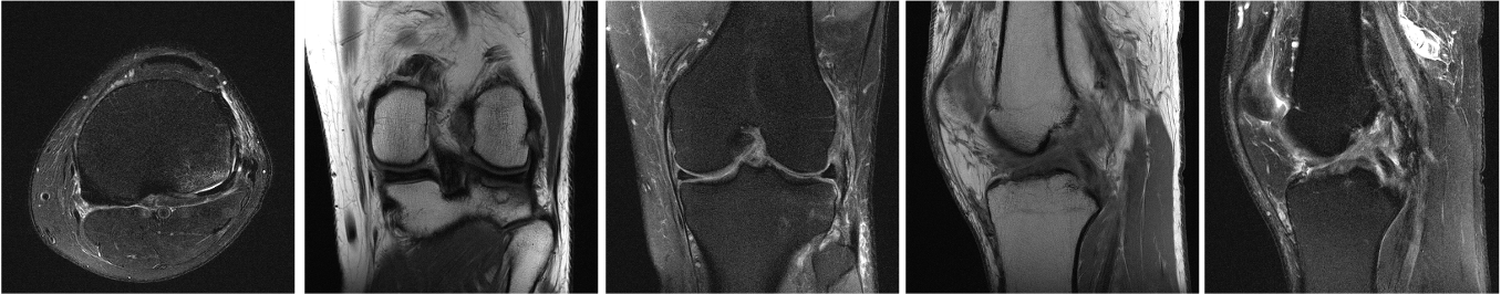 Image 2. MRI images from a typical clinical knee protocol, showing the knee in different orientations and with different image contrasts, created depending on the acquisition settings of the MRI scanner. Courtesy of Florian Knoll.