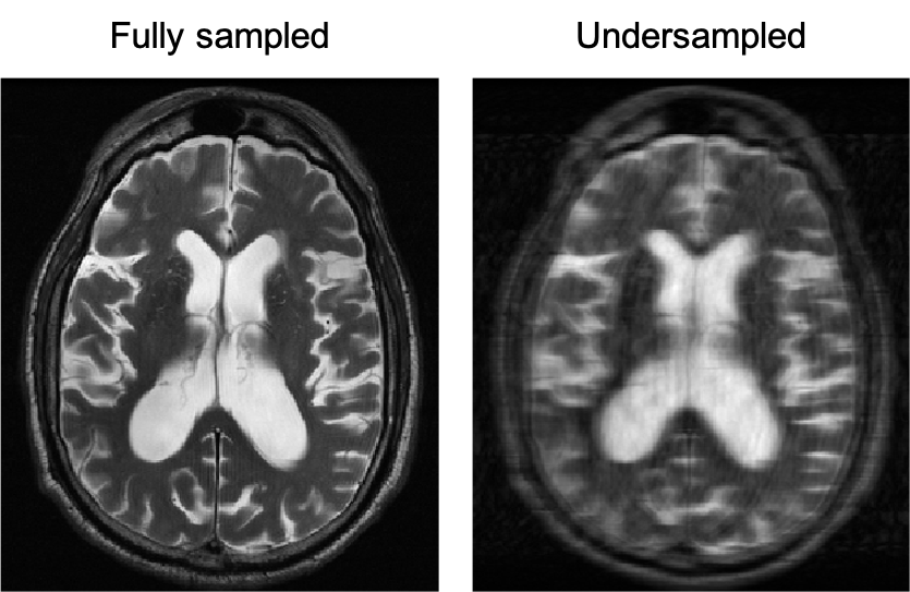 Image 3. A fully sampled versus a 4X undersampled MRI of the brain. Courtesy of Florian Knoll.