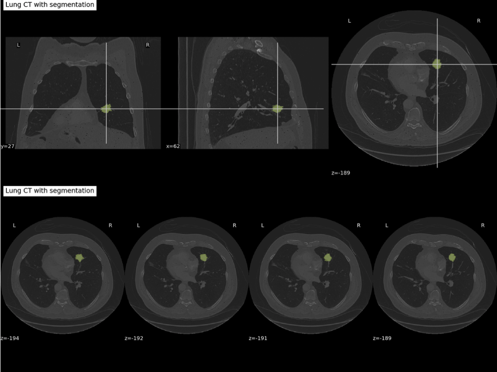 Example visualization of a CT scan, with lung tumor mask overlaid in yellow