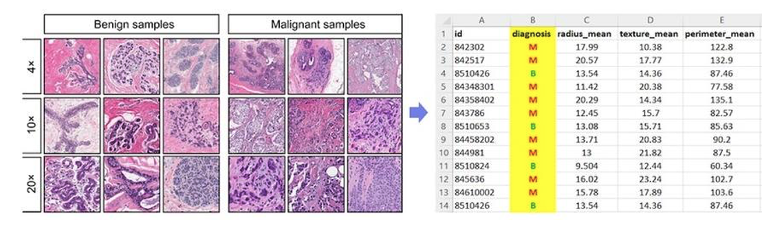 Figure 2: Images from Breast Cancer Wisconsin (Diagnostic) Dataset aligning with tabular data showing that samples are either malignant or benign.